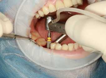 O întrebare des adresată în rândul stomatologilor: Pot afla un preț pentru implant dentar?